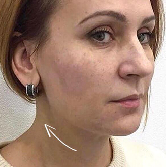 Обличчя після процедури